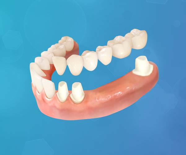 protesis-dental-fija-italprodent