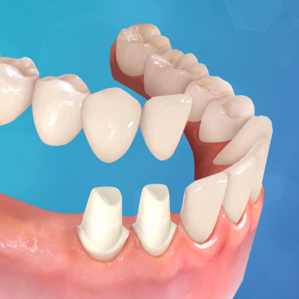 protesis-dental-fija-sobre-diente-natural_italprodent