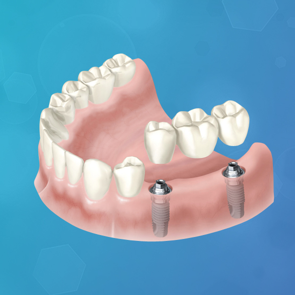 protesis-dental-sobre-implante-de-carga-inmediata-italprodent