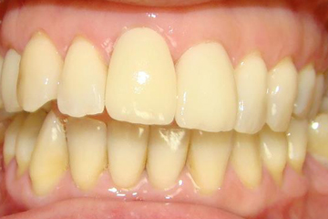 CORONAS-CEMENTADAS-E-MAX-11-Y-12_resultado-italprodent-laboratorio-dental