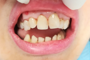 protesis-dental-fija-zirconio-antes-trabajos-laboratorio-dental-italprodent