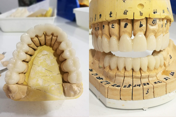 protesis-dental-fija-zirconio-trabajo-laboratorio-dental-italprodent